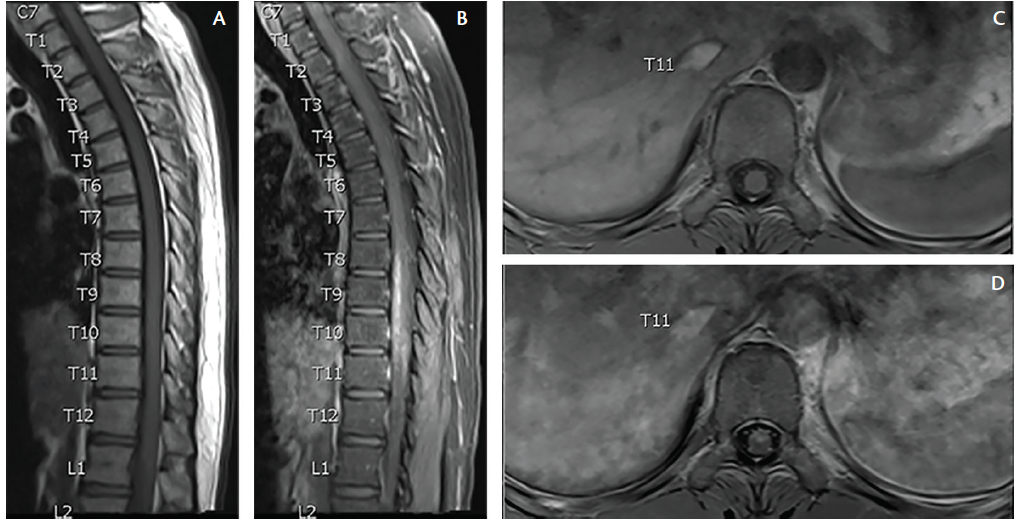 Neuroschistosomiasis Practical Neurology