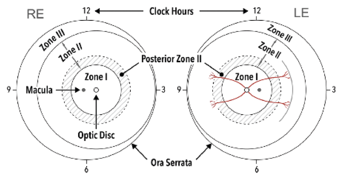 Retinopathy Of Prematurity Zones