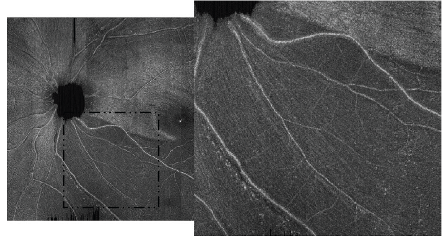 Retinal Nerve Fiber Layer Optical Texture Analysis Glaucoma Today