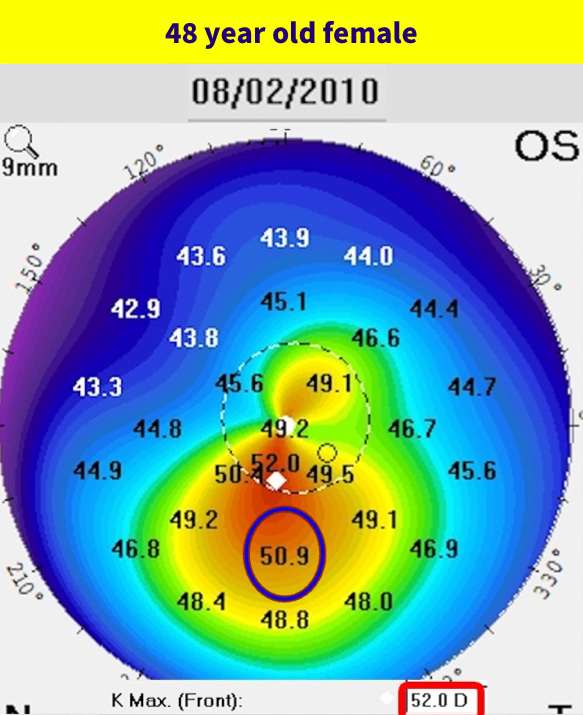 Collaborative Case 009 Two Cases of Keratoconus Modern Optometry
