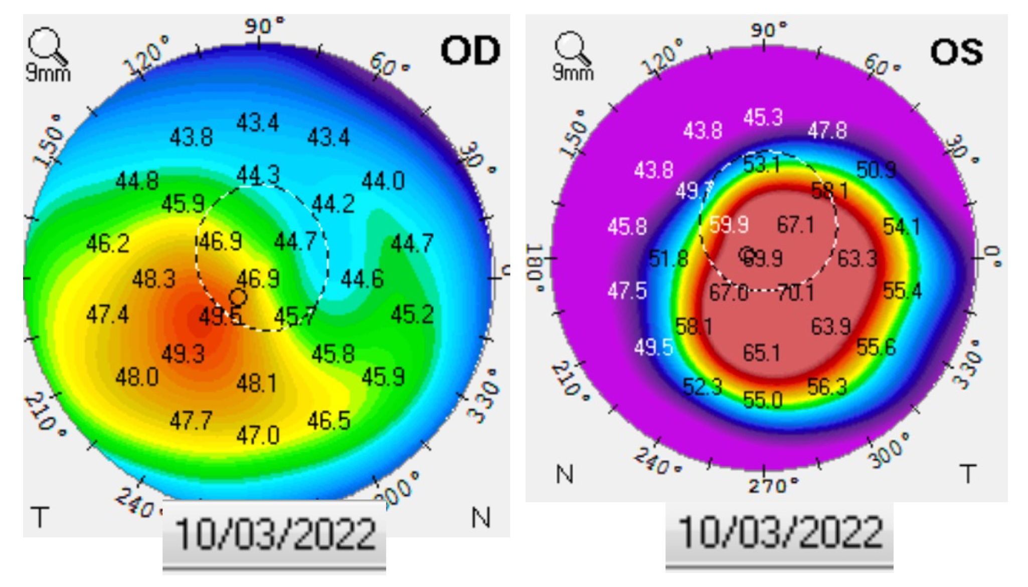 Collaborative Case 009 Two Cases of Keratoconus Modern Optometry