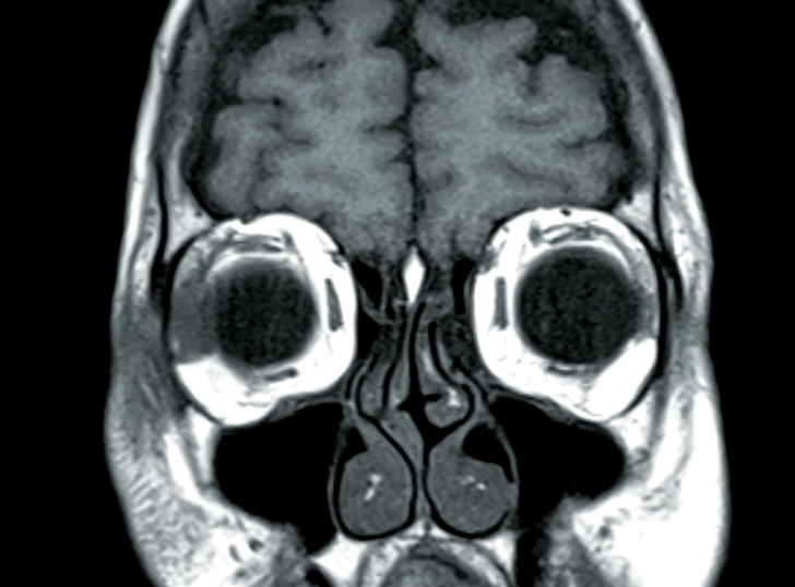 Orbital Disorders Modern Optometry