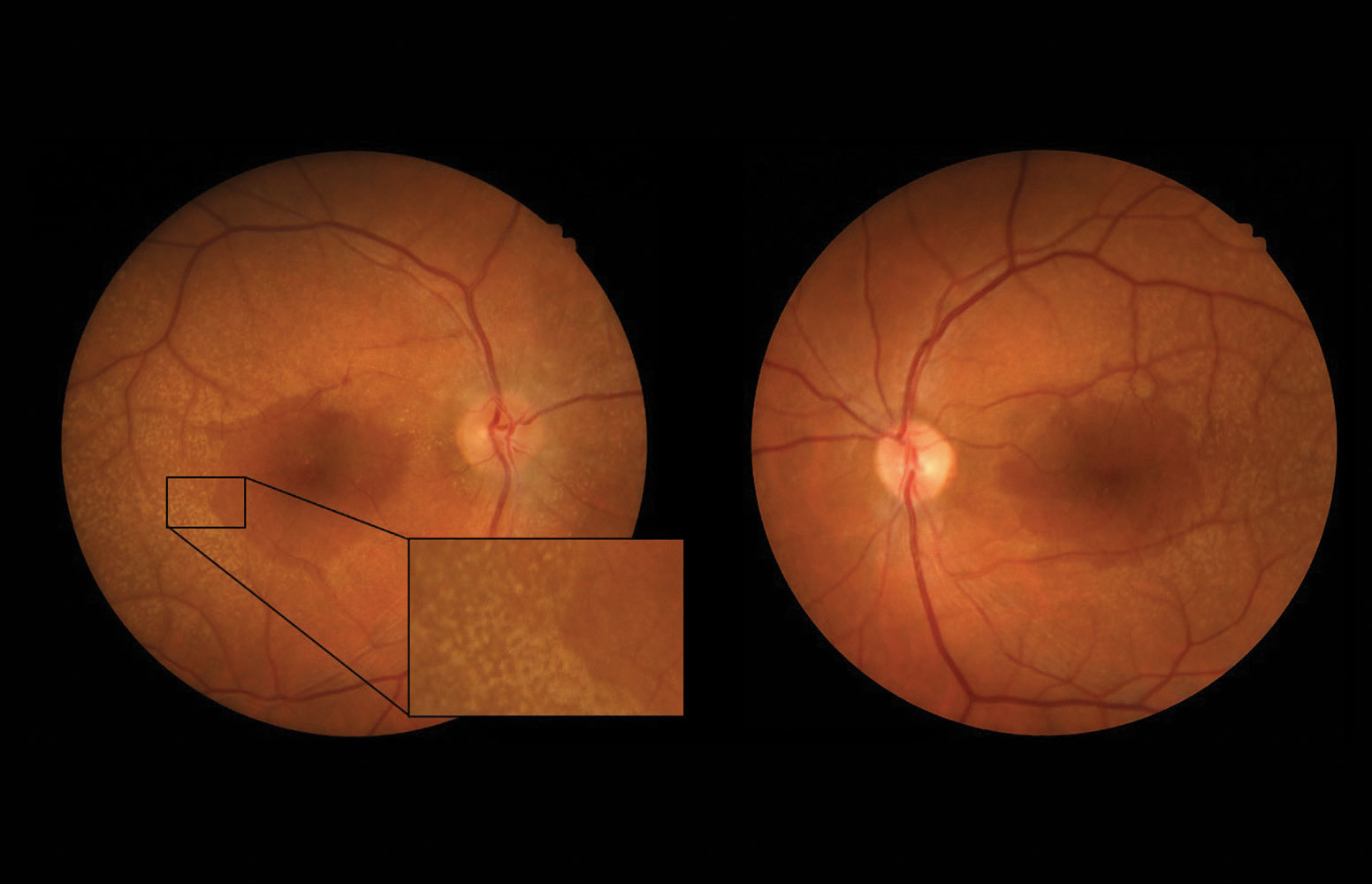 Retinal Findings In Alport Syndrome - Retina Today