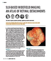 SLO-Based Widefield Imaging: An Atlas of Retinal Detachments image