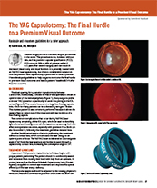The YAG Capsulotomy: The Final Hurdle to a Premium Visual Outcome image