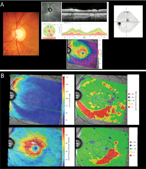 Screening and Establishing a Diagnosis With OCT - Glaucoma Today