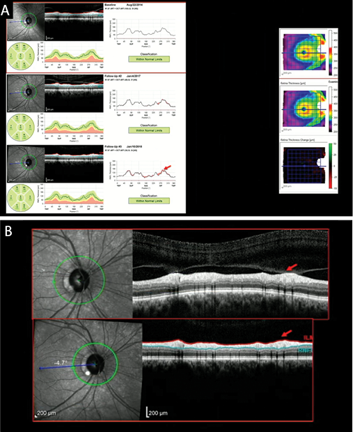 Screening and Establishing a Diagnosis With OCT - Glaucoma Today