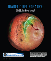 DIABETIC RETINOPATHY: 20/25, for How Long? image