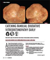 Catching Familial Exudative Vitreoretinopathy Early image