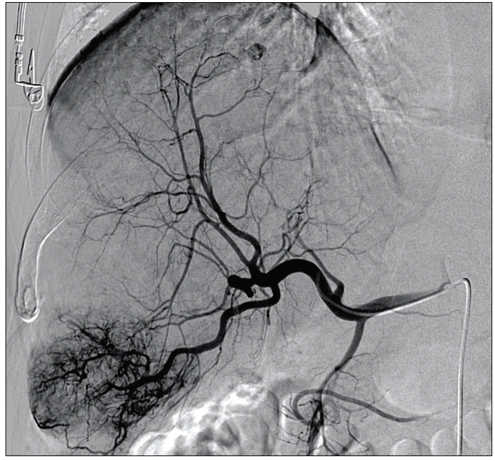 Transarterial Chemoembolization With The Sequre® Microcatheter