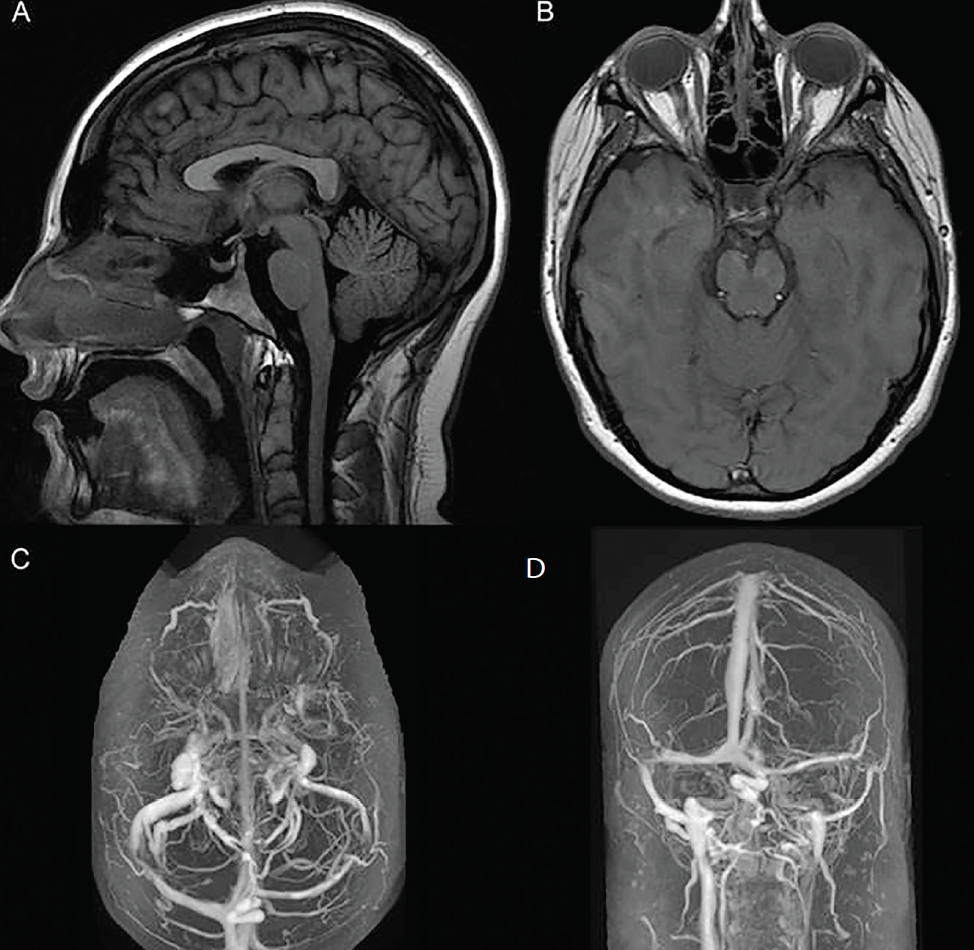 Idiopathic Intracranial Hypertension Practical Neurology