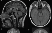 Idiopathic Intracranial Hypertension - Practical Neurology