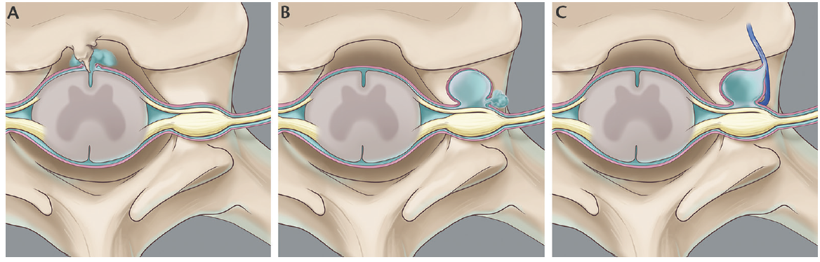 spinal fluid leak after lumbar surgery