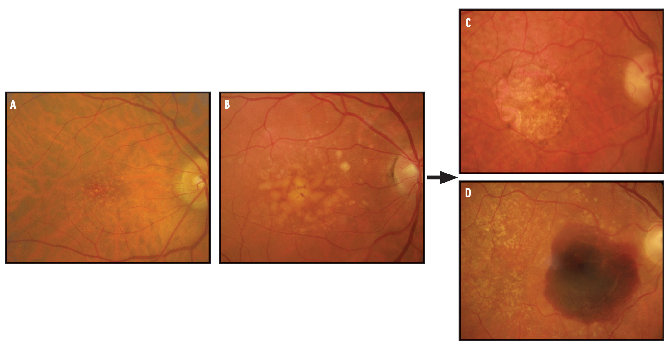 Rethinking Our AMD Nomenclature - Retina Today