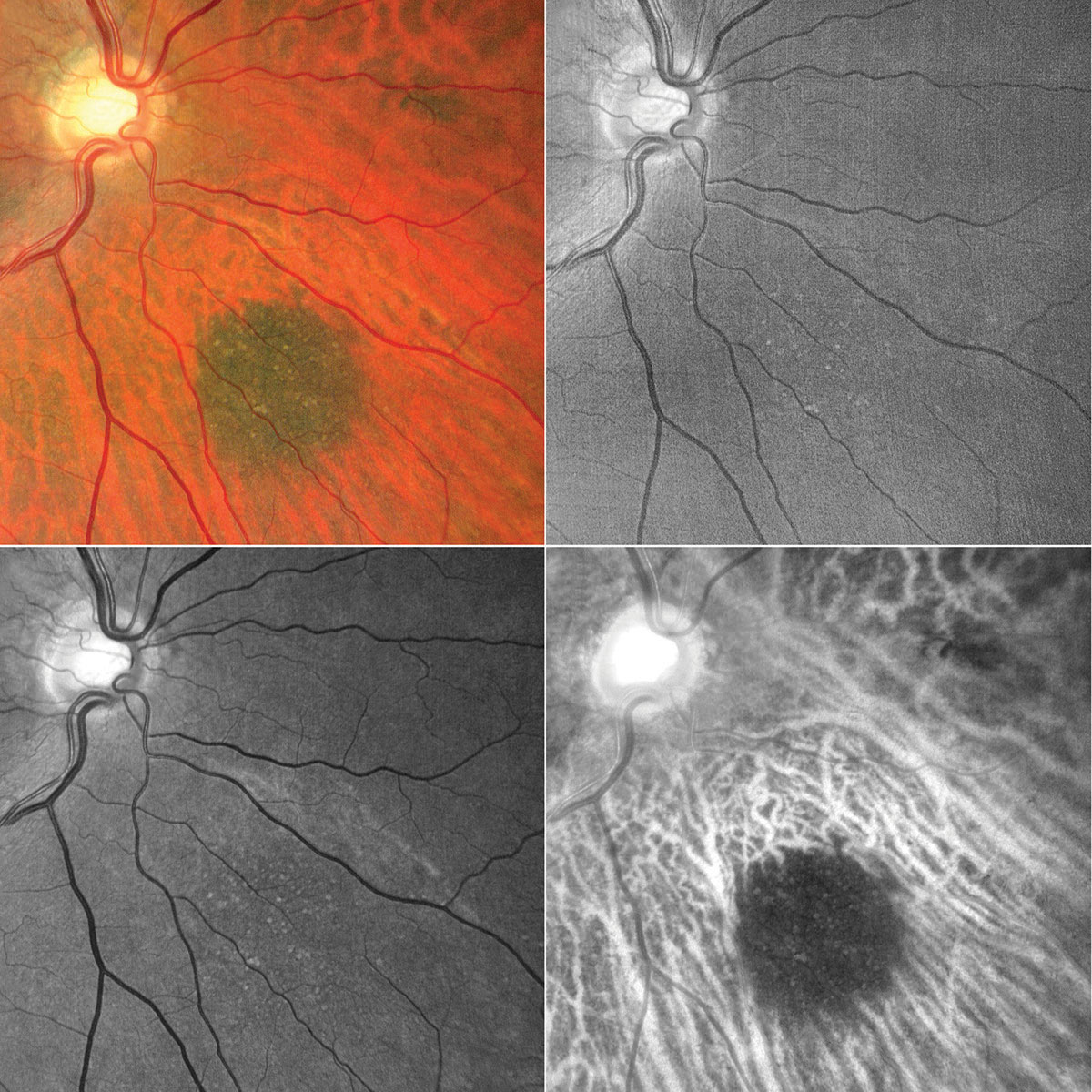 Let’s Talk About Retinal Imaging Analysis - Retina Today