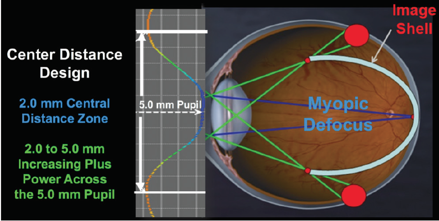 myopia-control-with-multifocal-contact-lenses-modern-optometry