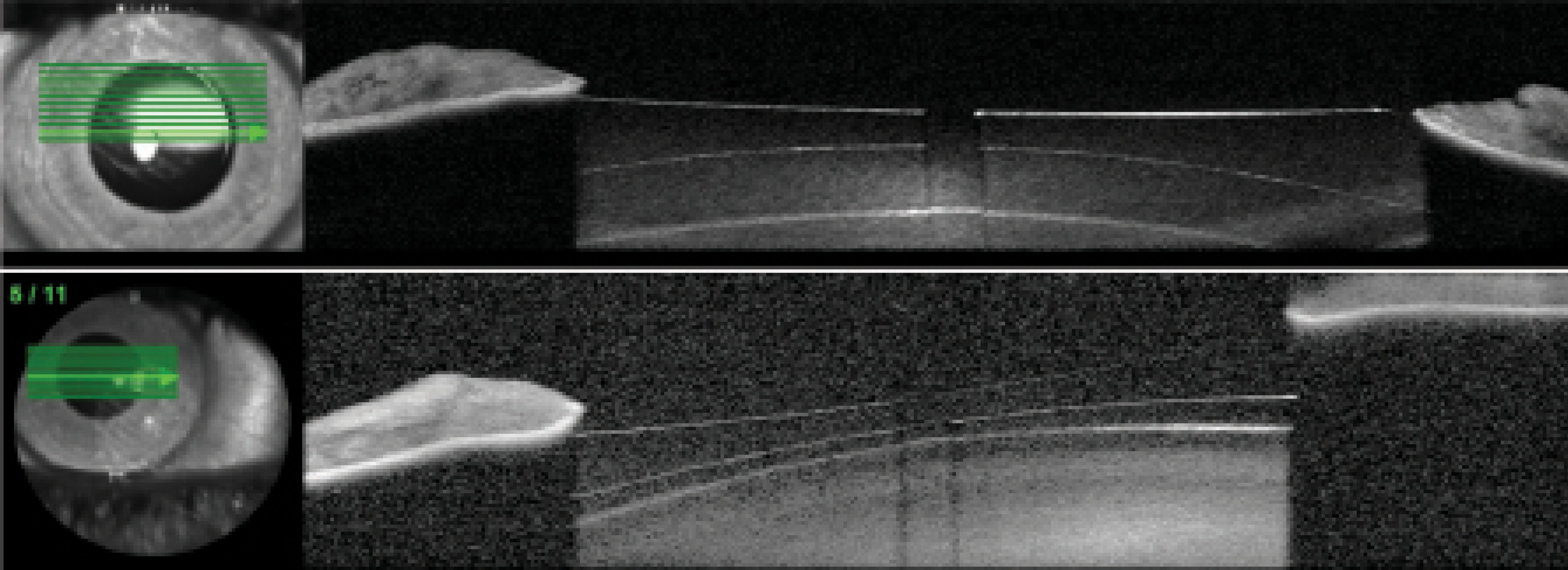 Decreasing Vaulting of a Phakic IOL YoungMD Connect