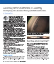 Addressing Barriers to Wider Use of Gonioscopy image