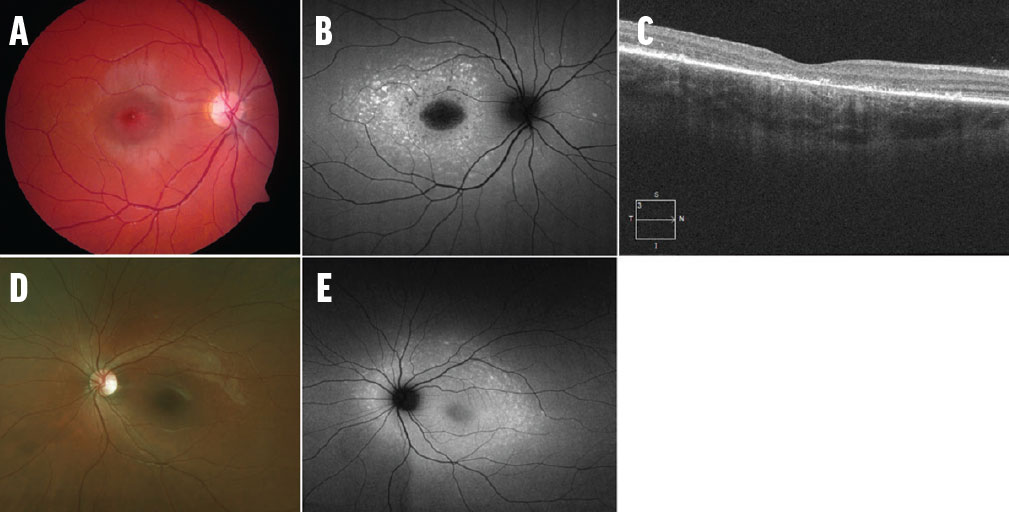 Today's Imaging Approaches for IRD - Retina Today