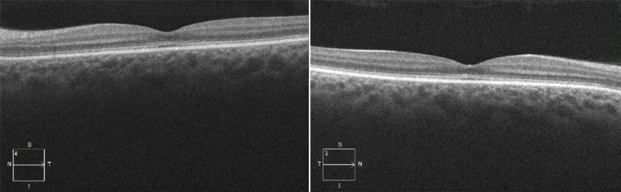 Today's Imaging Approaches for IRD - Retina Today