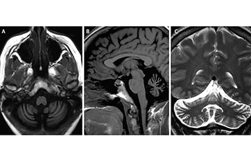 Immune Mediated Cerebellar Ataxias Practical Neurology   0920 CF7 Fig 1600264159 