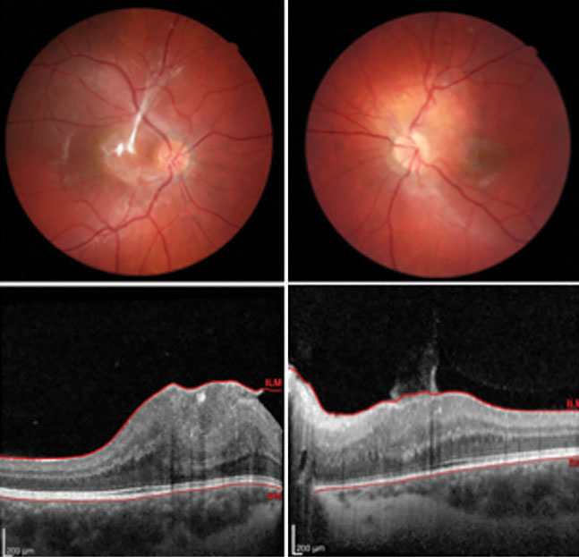 Combined Hamartoma of the Retina and RPE Retina Today