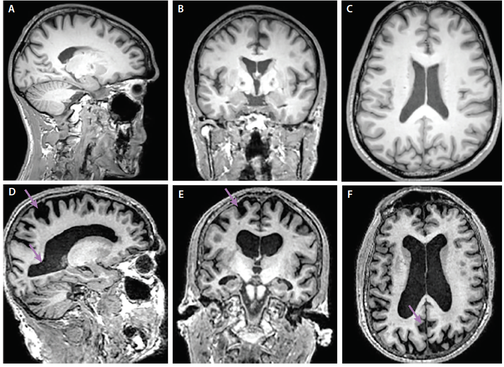 Neuroimaging And Alzheimers Disease Practical Neurology