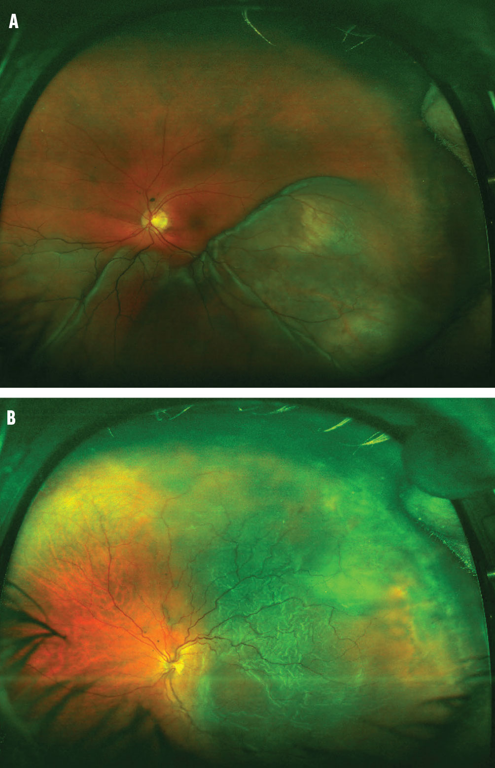 the-benefits-of-vitrectomy-for-uveal-melanoma-retina-today