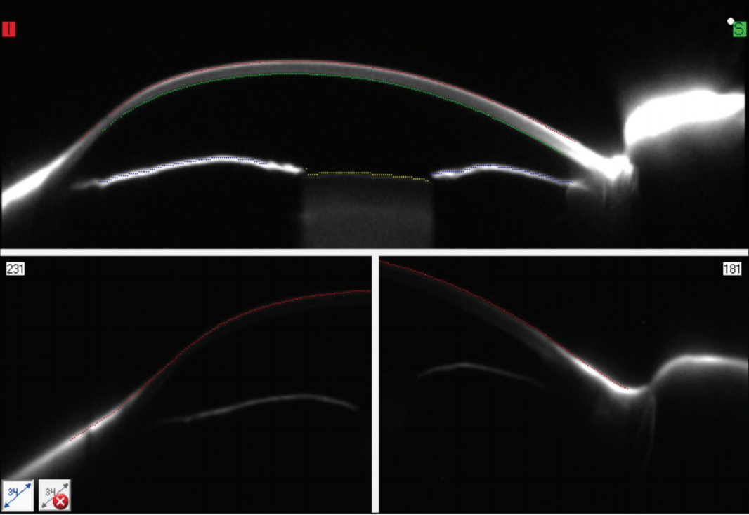Pentacam CSP Software to Improve Efficiency and Efficacy of Complex