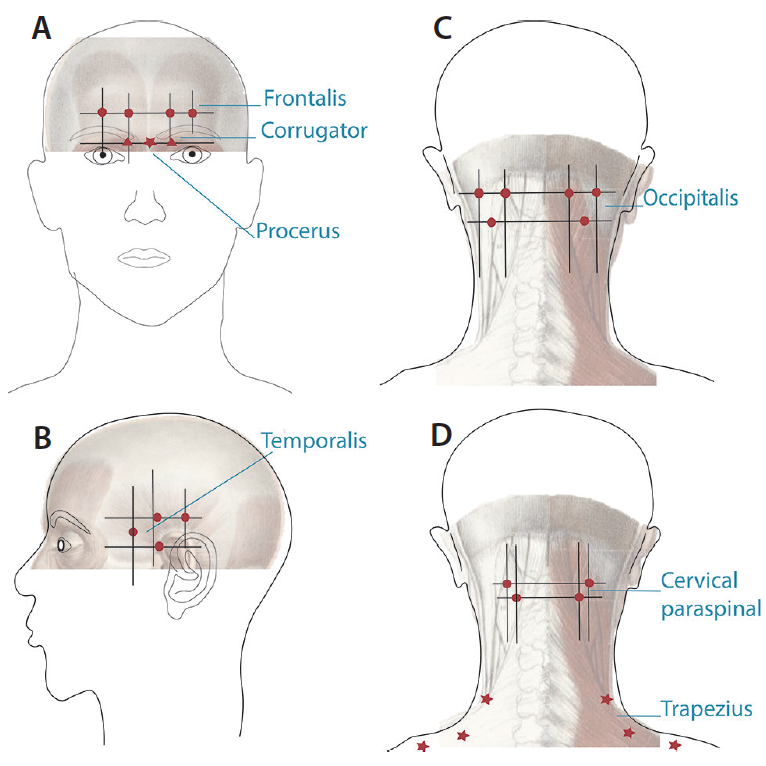 Procedural Treatments For Headache Disorders Practical Neurology