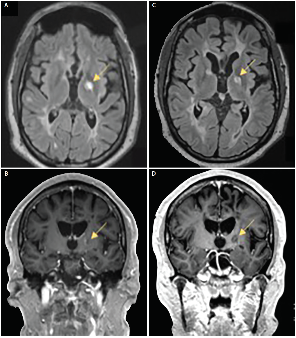 View Multiple Sclerosis Mri Scan Normal Vs Abnormal Brain Mri Pictures