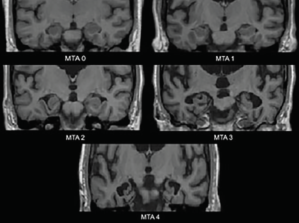 Figure 1. Classificação da escala de atrofia temporal medial (MTA). MTA 0-não ao espaçamento mínimo da fissura coróide; MTA 1-alargamento da fissura coróide; MTA 2-alargamento adicional da fissura coróide que se funde com o corno temporal do ventrículo lateral, leve diminuição da altura da formação hipocampal; MTA 3-diminuição moderada da altura da formação hipocampal, aumento proeminente do corno temporal do ventrículo lateral; MTA 4-diminuição severa da altura da formação hipocampal, aumento proeminente do corno temporal do ventrículo lateral.