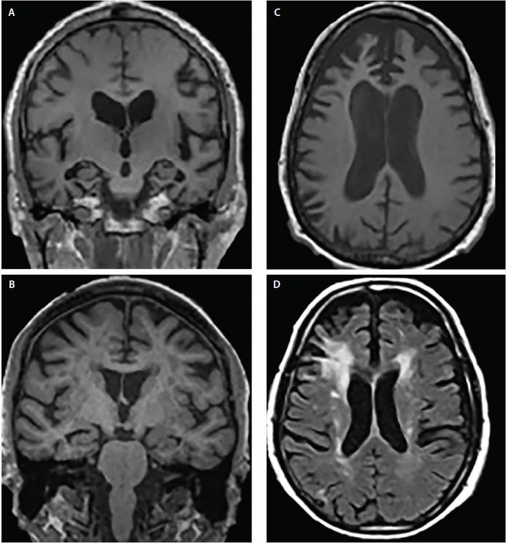  2. ábra. Az Alzheimer-kór (AD) (A), a Lewy-testes demencia (DLB) (B), a frontotemporális demencia (FTD) (C) és a vaszkuláris demencia (VaD) (D) strukturális atrófia mintázatai. A koronális T1-súlyozott MRI általános agykérgi atrófiát, de különböző mértékű hippokampusz-atrófiát mutat AD-ben (A) és DLB-ben (B). Az axiális T1-súlyozott MRI a bvFTD atrófiáját mutatja, a medialis és laterális prefrontális agykérgeket érintő fokális preferenciával (C). A tengelyirányú T2-súlyozott MRI konfluens periventrikuláris sapka- és halo fehérállomány-hypointenziókat (WMH-k) mutat, amelyek a corona radiatát érintik és a laterális prefrontális neokortexbe terjednek, enyhe szórt WMH-kat és WMH-kat a subependymalis kamrai bélésen és a septum pellucidumon VaD-ben (D).