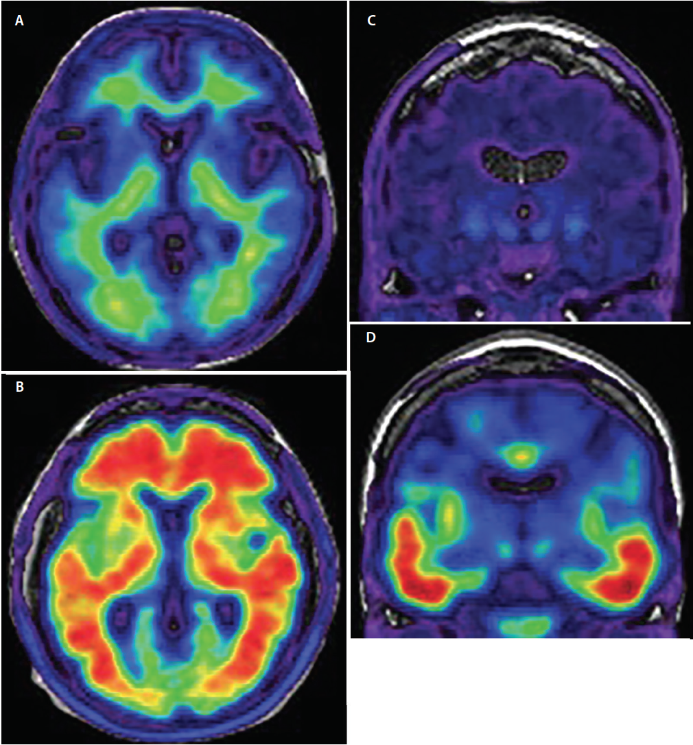 Figure 3. Axial amilóide-PET demonstrando amilóide negativo (A) e amilóide positivo (B). Em imagens negativas amilóides (A) o sinal do radiotraçador mostra baixa intensidade e é limitado à ligação não específica de matéria branca. A junção cinza/matéria branca é preservada. Nas imagens positivas amilóides (B) o sinal do radiotraçador é de alta intensidade e se estende difusamente para as regiões de matéria cinzenta cortical obscurecendo a junção cinza/matéria branca. O tau-PET coronal demonstra varreduras tau negativas (C) e tau positivas (D). Nas varreduras tau negativas há sinal mínimo, não específico de baixa intensidade do radiotraçador nas regiões temporal medial, basal forebrain e gânglios basais. Nas varreduras tau-positivas (D) o sinal do radiotraçador é de maior intensidade e envolve os corticais temporais inferior e lateral seguindo a trajetória conhecida de progressão dos emaranhados neurofibrilares.