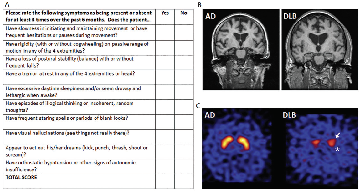 lewy body composite risk score - lewy body dementia life expectancy