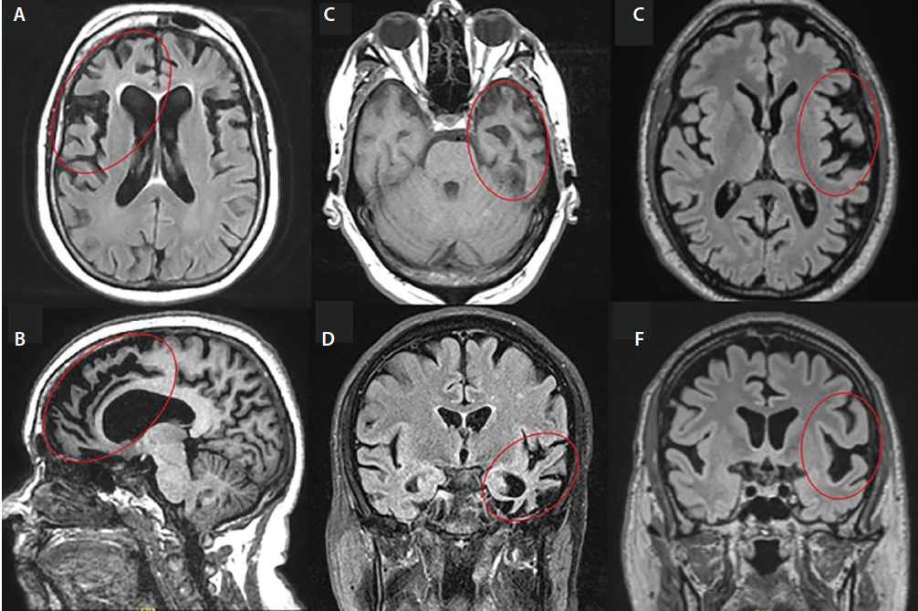 Frontotemporal Dementias - Practical Neurology