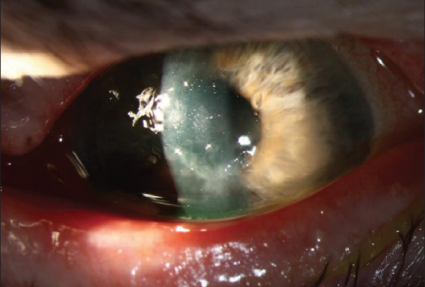 A Primer on Herpes Simplex Keratitis - Modern Optometry