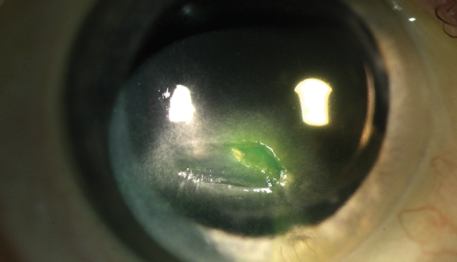 A Primer on Herpes Simplex Keratitis Modern Optometry