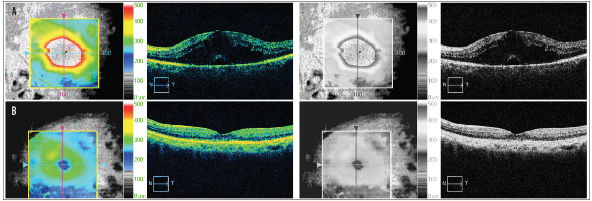 Medical Management Of Diabetic Retinopathy - Modern Optometry