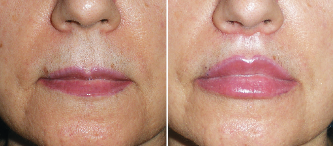 Before And After Mohs Surgery Upper Lip