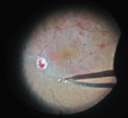 repairing a detached retina