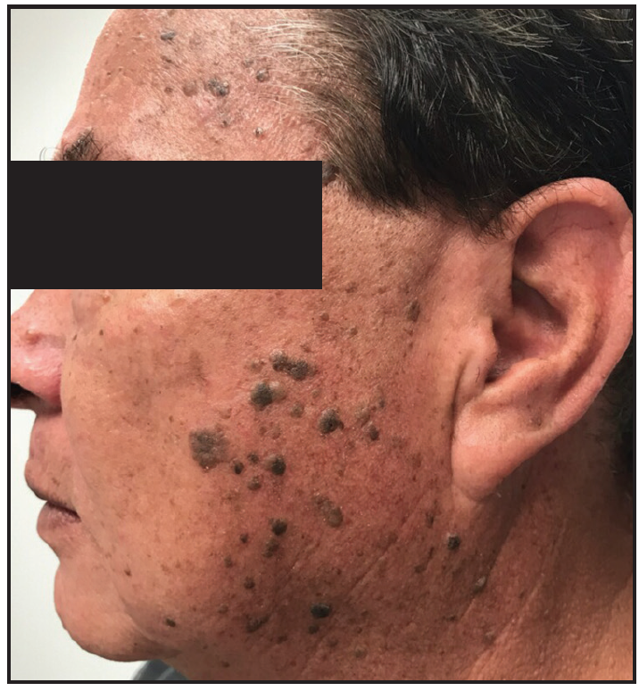 Home Remes For Seborrheic Keratosis On Face Bios Pics