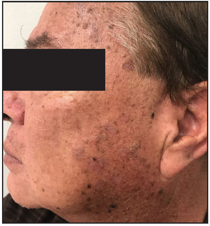 New Options For The Treatment Of Extensive Seborrheic Keratosis