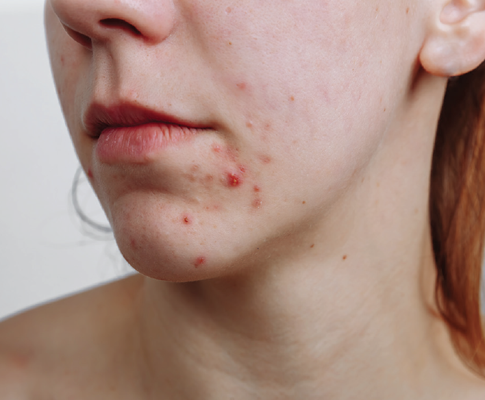 Clascoterone A Novel Topical Anti Androgen For The Treatment Of Acne Practical Dermatology