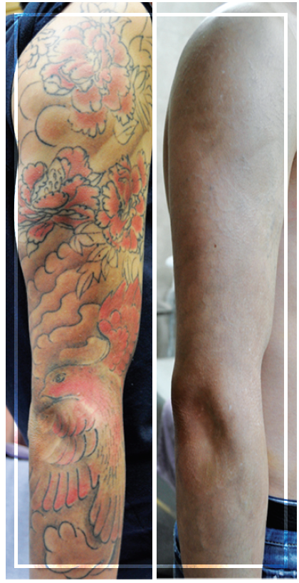 Picosecond Lasers Meeting Advanced Tattoo Removal And Changing Demographics Needs Modern Aesthetics