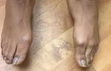 Continuous Movement of the Toes - Practical Neurology Continuous Movement of the Toes - Practical Neurology