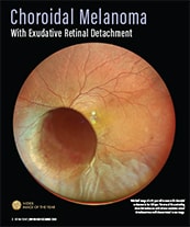 Choroidal Melanoma With Exudative Retinal Detachment image
