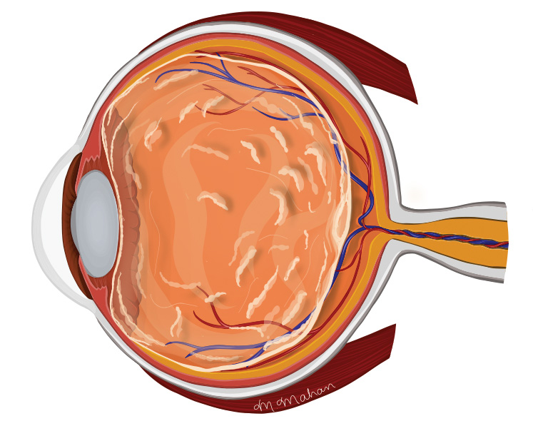 Best Practices on Referring Patients With Symptomatic Vitreous Opacities Retina Today