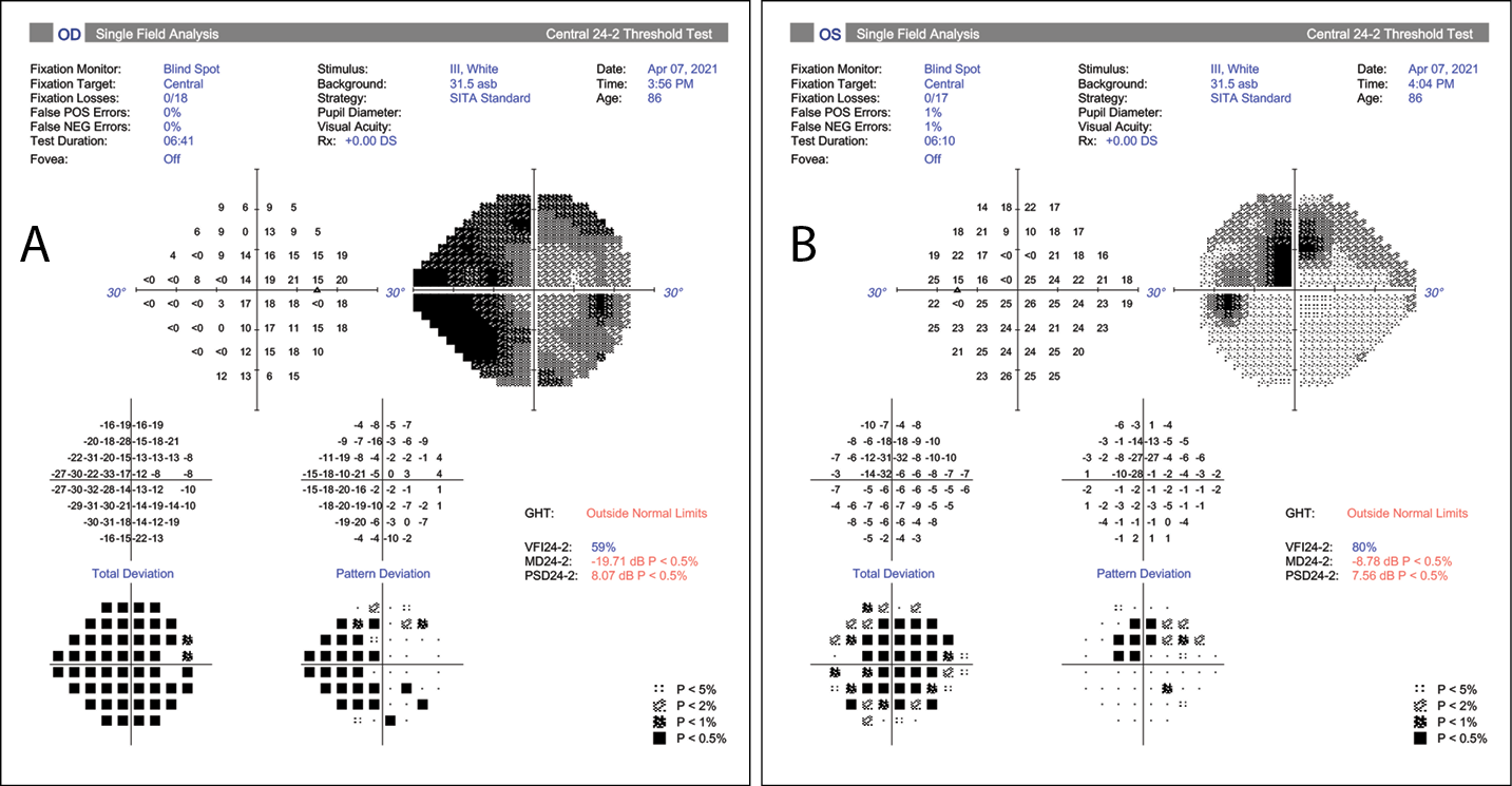Treatment for Vitreous Expansion Syndrome Related to AgeRelated