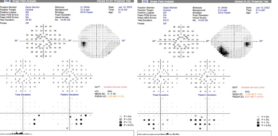 Glaucoma or Long COVID - Glaucoma Today